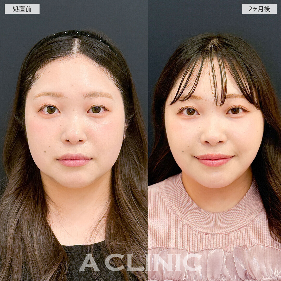 1day小顔脂肪吸引で頬のボリュームが減り更に垢抜けました！こちら処置前と2ヶ月後の症例です(20代女性)