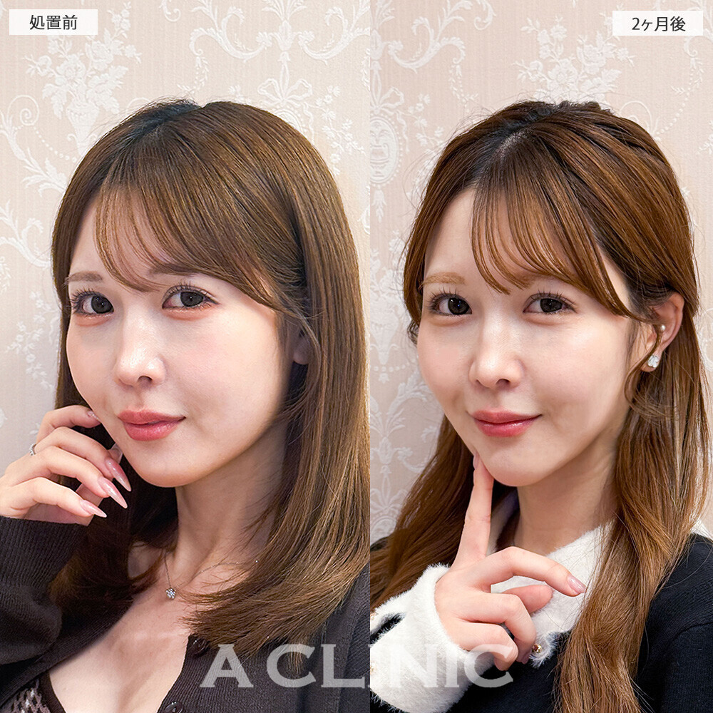 1day小顔脂肪吸引でみんなも羨ましがる理想の輪郭に！こちら処置前と2ヶ月後の症例です(20代女性)