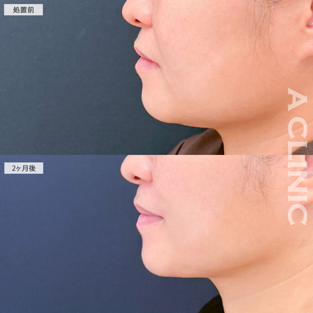 1day小顔脂肪吸引とバッカルファット除去術と小顔エラボトックスでお顔の余白がグッと減りました！こちら処置前と2ヶ月後の症例です(30代女性)