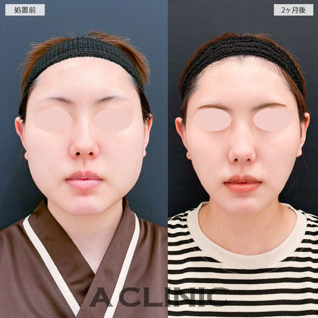 1day小顔脂肪吸引と小顔エラボトックスでお顔全体のボリュームが減りました！処置前から2ヶ月後の症例です(20代女性)