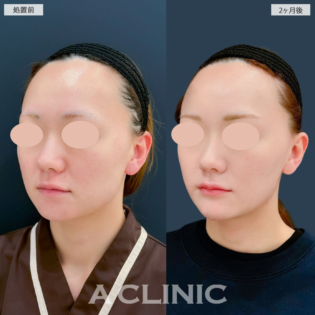 1day小顔脂肪吸引と小顔エラボトックスで余分な脂肪を除去しフェイスラインをしっかり引き上げました！こちら処置前と2ヶ月後の症例です(20代女性)