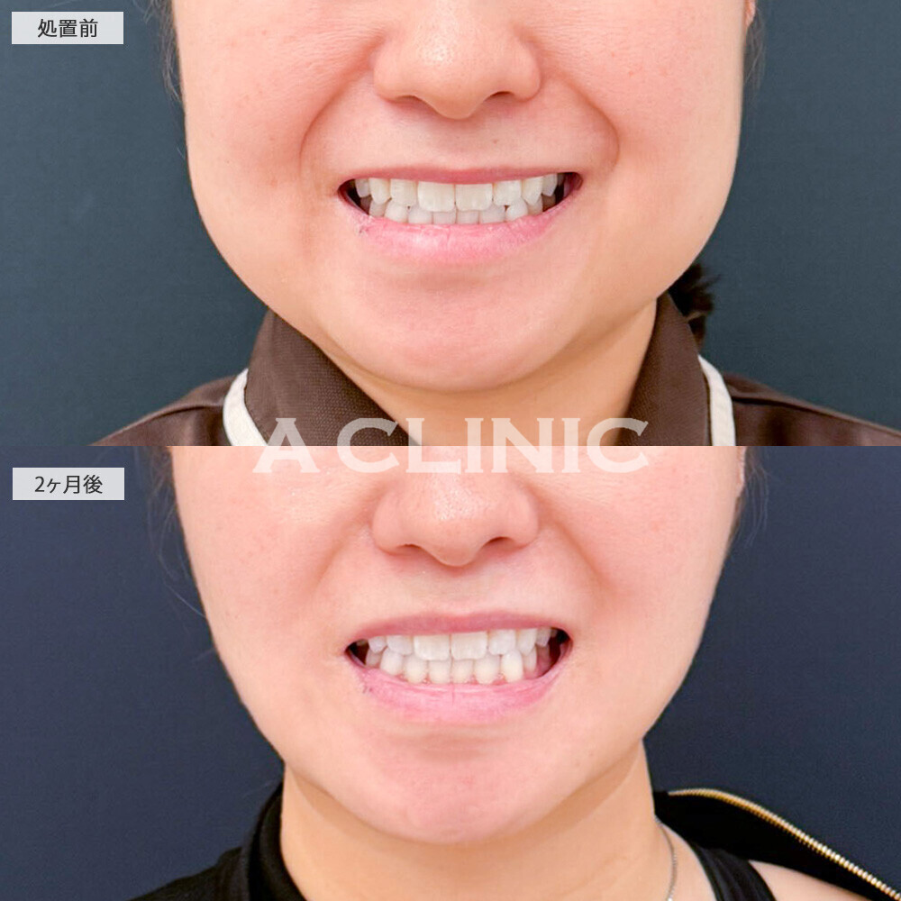 1day小顔脂肪吸引とバッカルファット除去術と小顔エラボトックスでお顔の余白がグッと減りました！こちら処置前と2ヶ月後の症例です(30代女性)