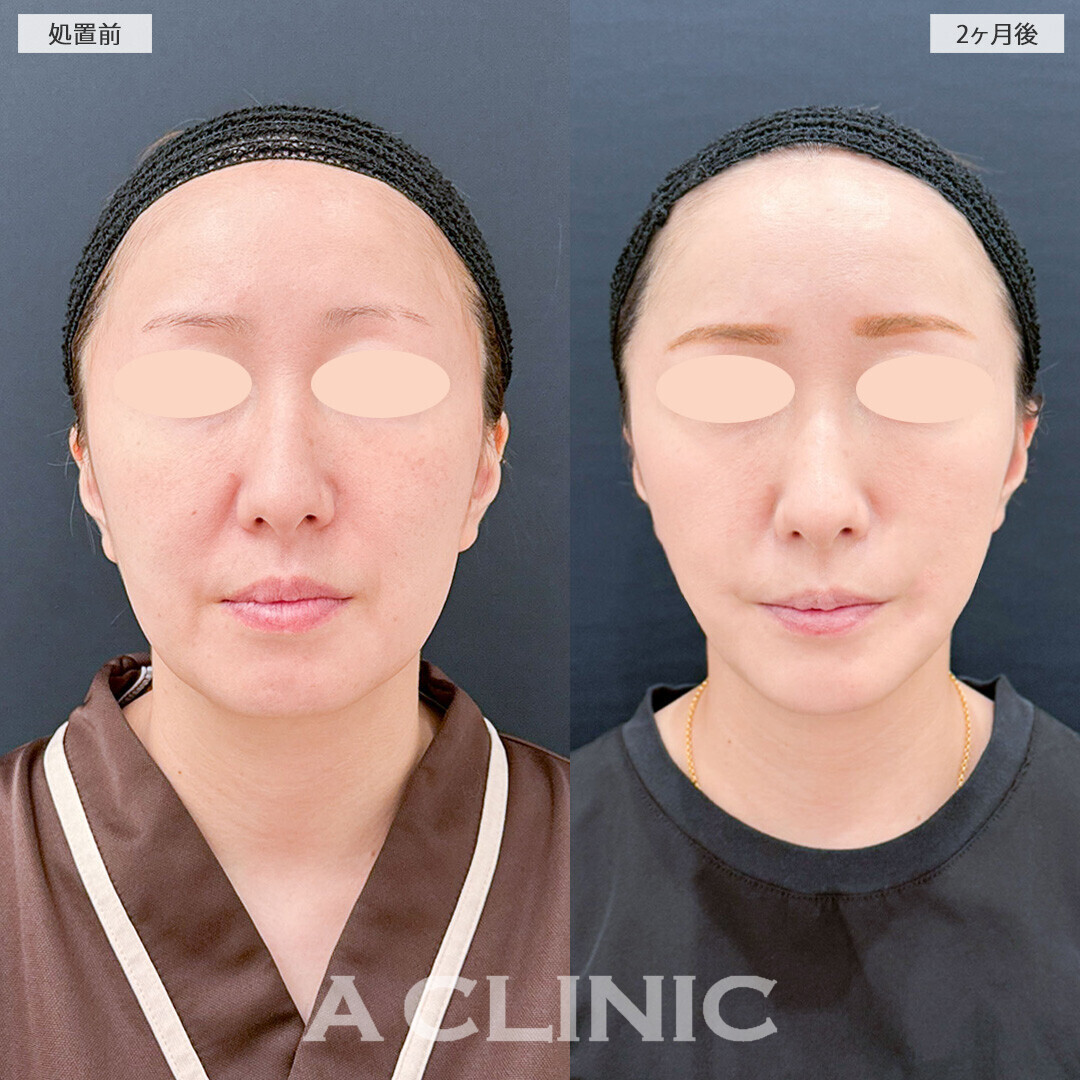 1day小顔脂肪吸引とあごへのヒアルロン酸注入とあごのボトックス注射でどこから見ても整った印象になりました！こちら処置前から2ヶ月後の症例です(40代女性)