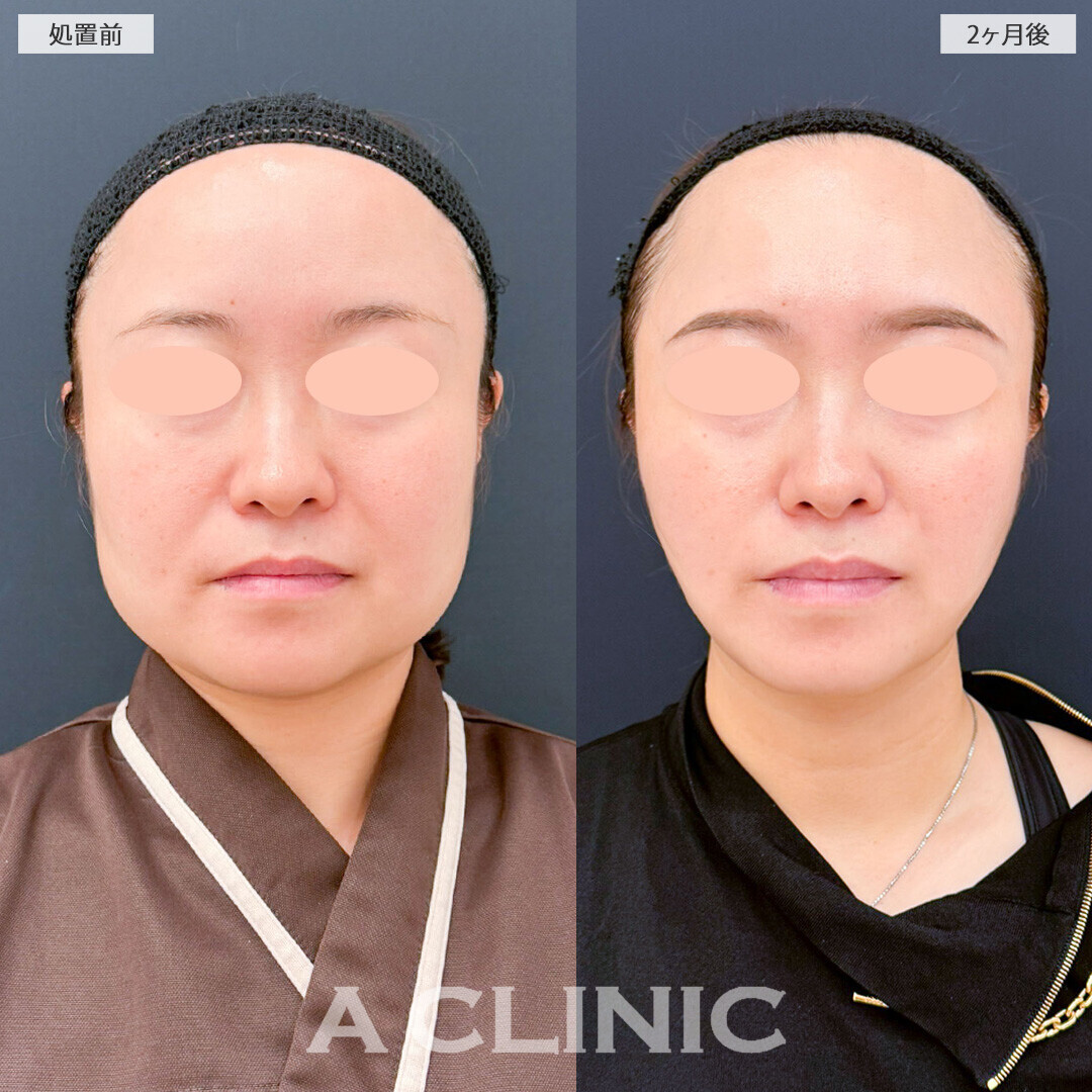 1day小顔脂肪吸引とバッカルファット除去術と小顔エラボトックスでお顔の余白がグッと減りました！こちら処置前と2ヶ月後の症例です(30代女性)