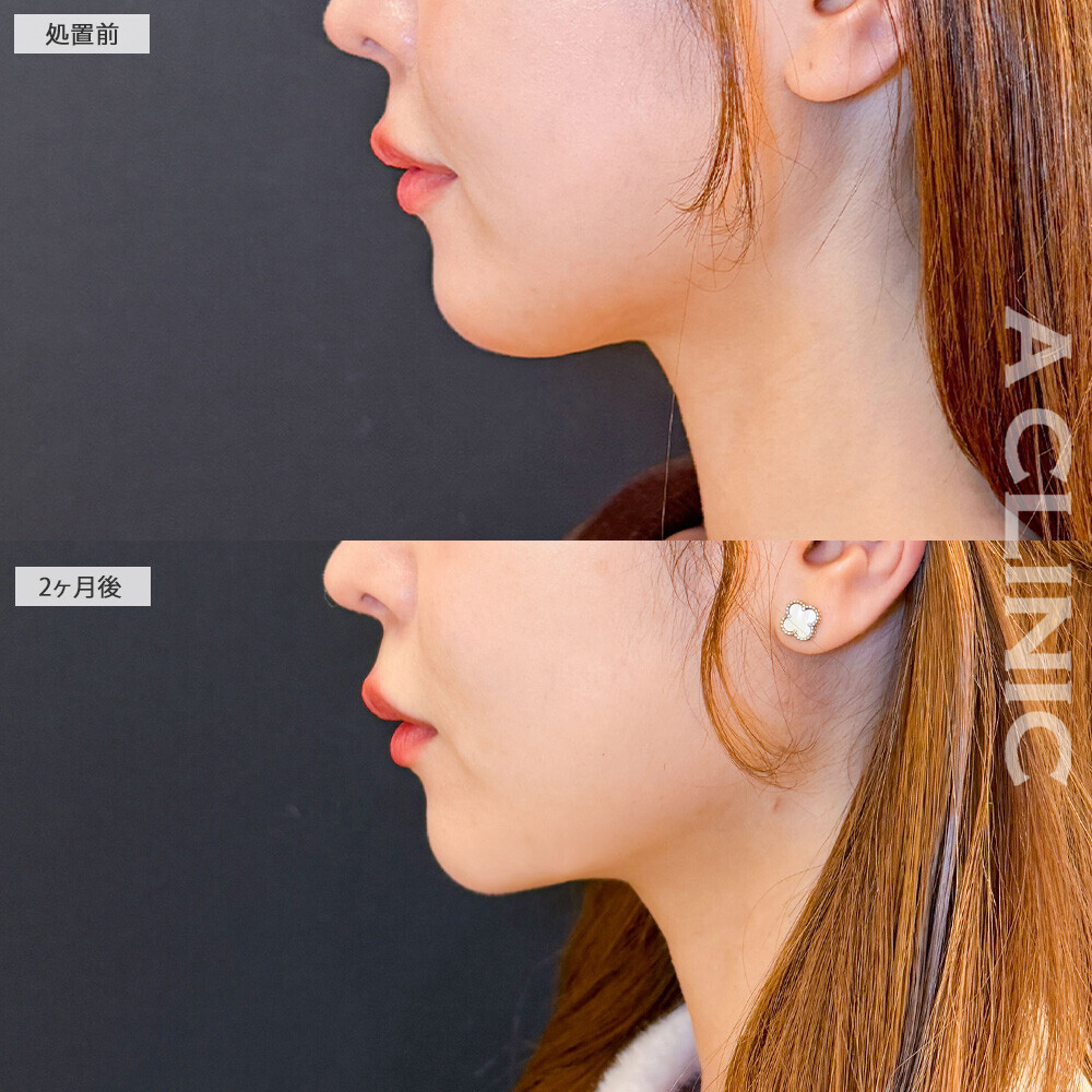 1day小顔脂肪吸引でみんなも羨ましがる理想の輪郭に！こちら処置前と2ヶ月後の症例です(20代女性)