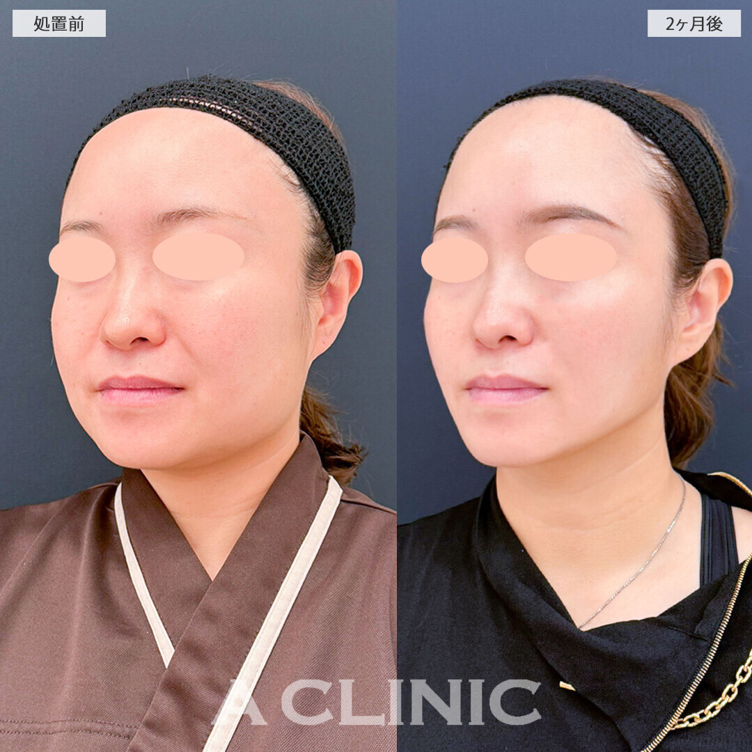 1day小顔脂肪吸引とバッカルファット除去術と小顔エラボトックスでお顔の余白がグッと減りました！こちら処置前と2ヶ月後の症例です(30代女性)