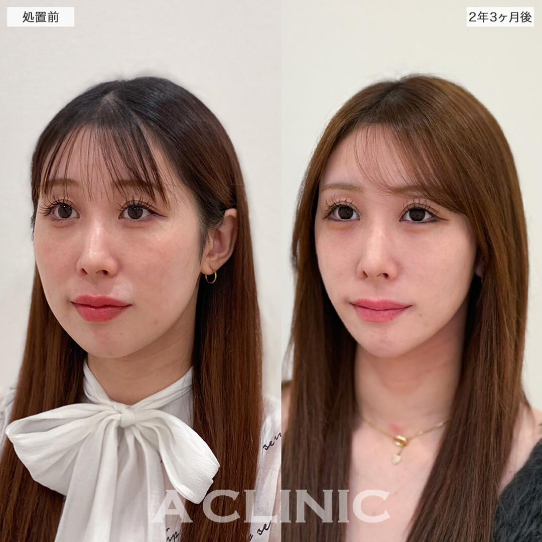1day小顔脂肪吸引は後戻りをせず半永久の美輪郭が叶います!こちら処置前と2年3ヶ月後の症例です(20代女性)