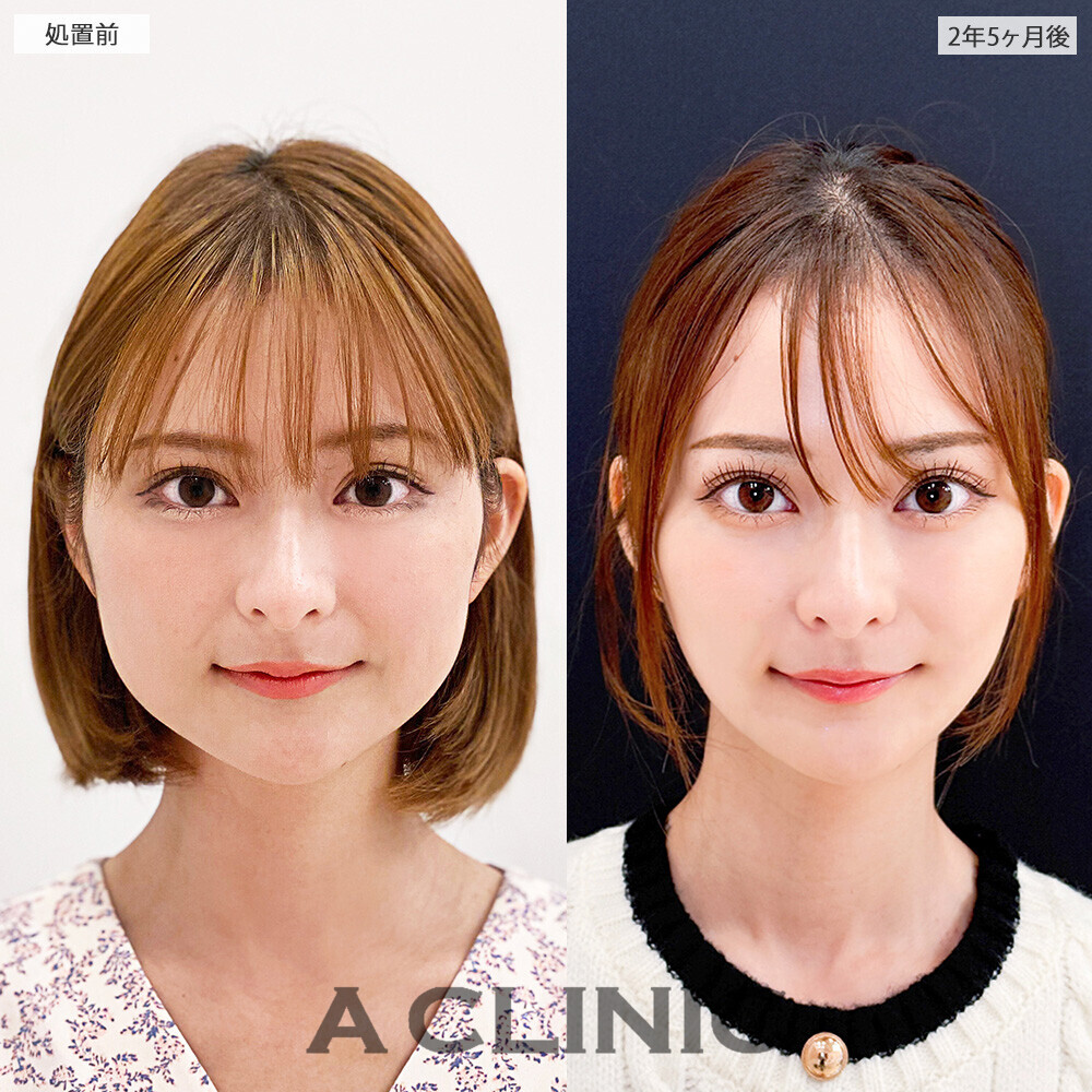 1day小顔脂肪吸引と小顔エラボトックスで約２年半経ってもリバウンドなし！こちら処置前と2年5ヶ月後の症例です(20代女性)