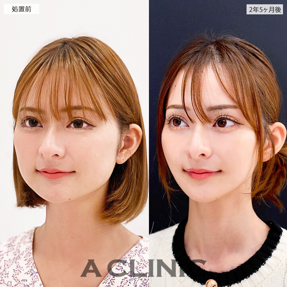 1day小顔脂肪吸引と小顔エラボトックスで約２年半経ってもリバウンドなし！こちら処置前と2年5ヶ月後の症例です(20代女性)