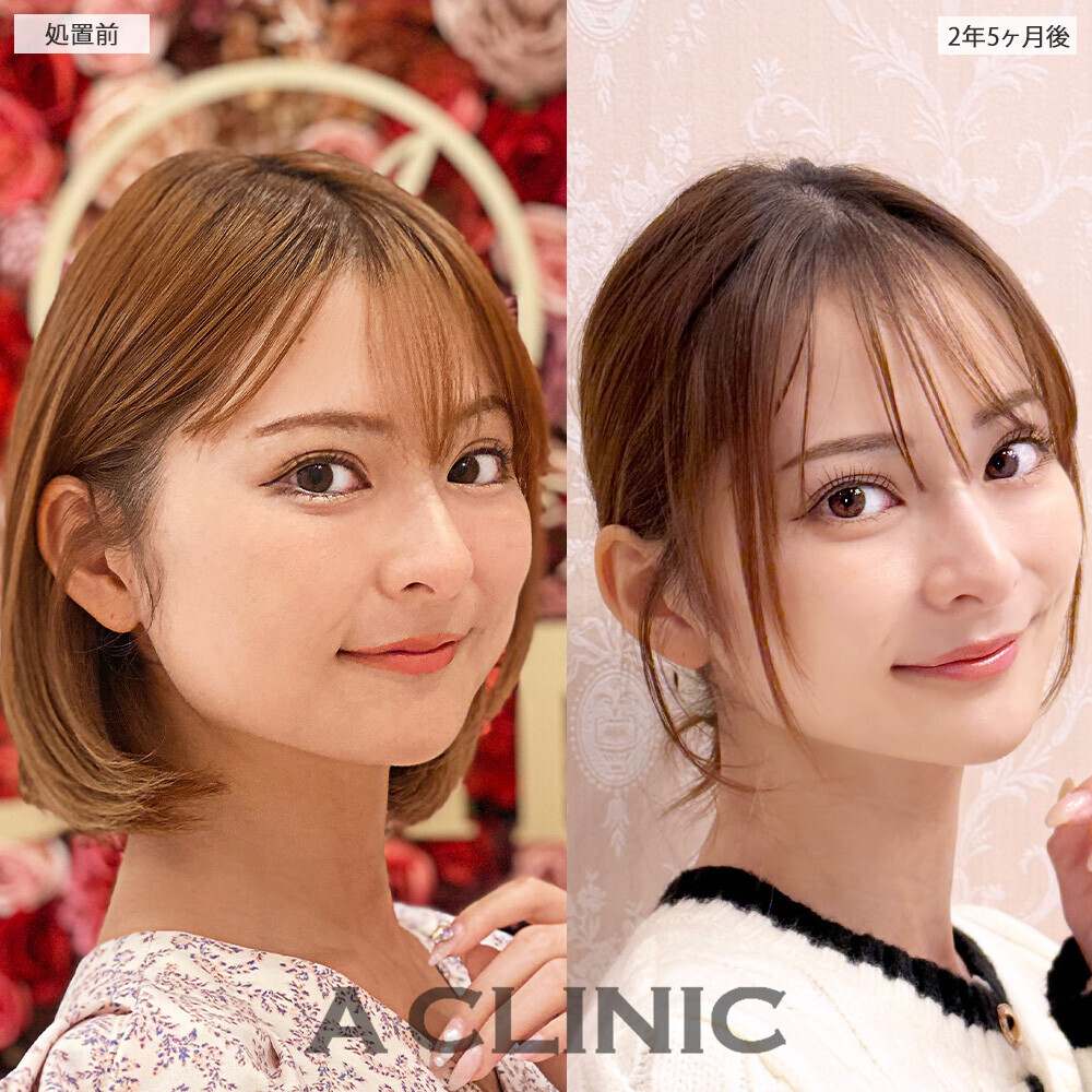 1day小顔脂肪吸引と小顔エラボトックスで約２年半経ってもリバウンドなし！こちら処置前と2年5ヶ月後の症例です(20代女性)