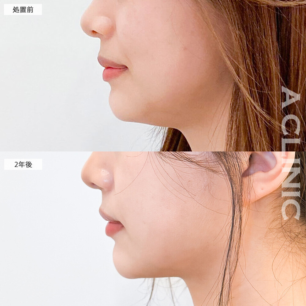 1day小顔脂肪吸引で爆美女に垢抜け！こちら処置前と2年後の症例です(10代女性)