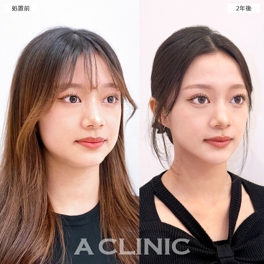 1day小顔脂肪吸引で爆美女に垢抜け！こちら処置前と2年後の症例です(10代女性)