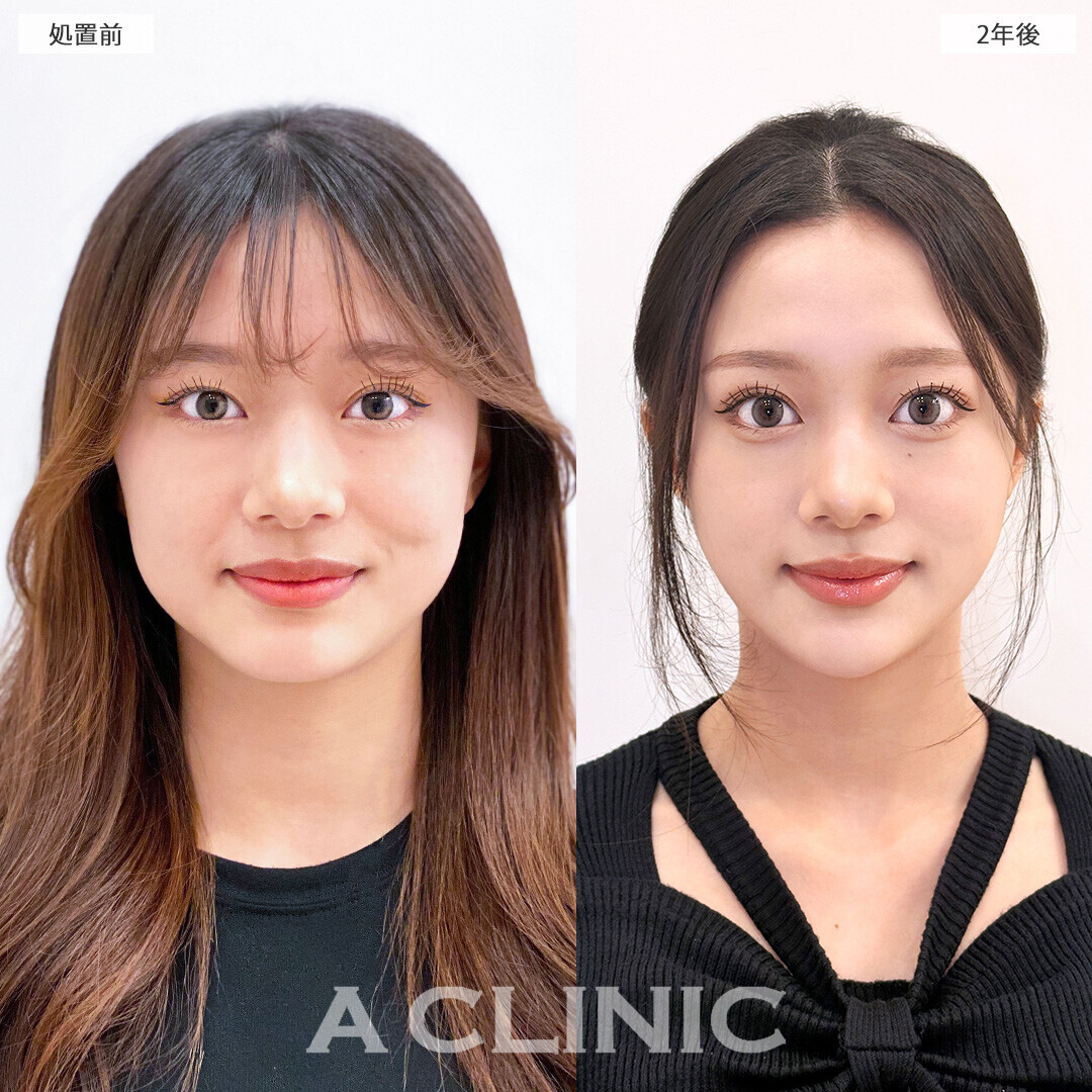 1day小顔脂肪吸引で爆美女に垢抜け！こちら処置前と2年後の症例です(10代女性)