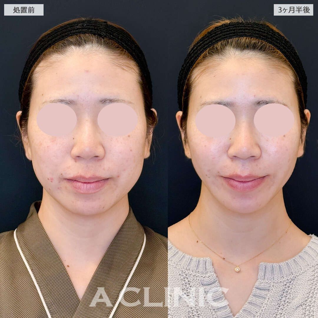 1day小顔脂肪吸引とバッカルファット除去術とで徐々にお顔の変化を実感できました！処置前と3ヶ月半後の症例です(30代女性)