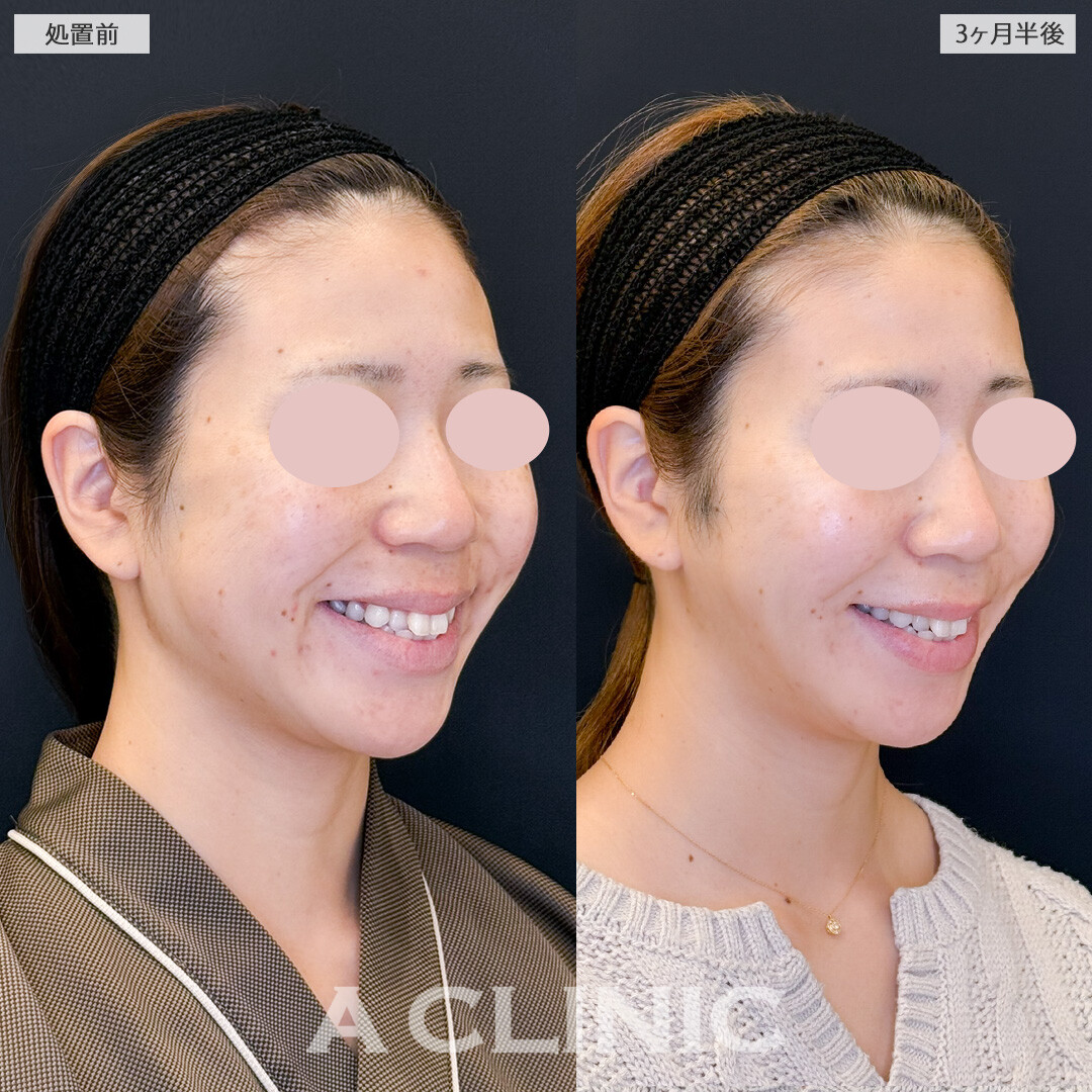 1day小顔脂肪吸引とバッカルファット除去術とで徐々にお顔の変化を実感できました！処置前と3ヶ月半後の症例です(30代女性)