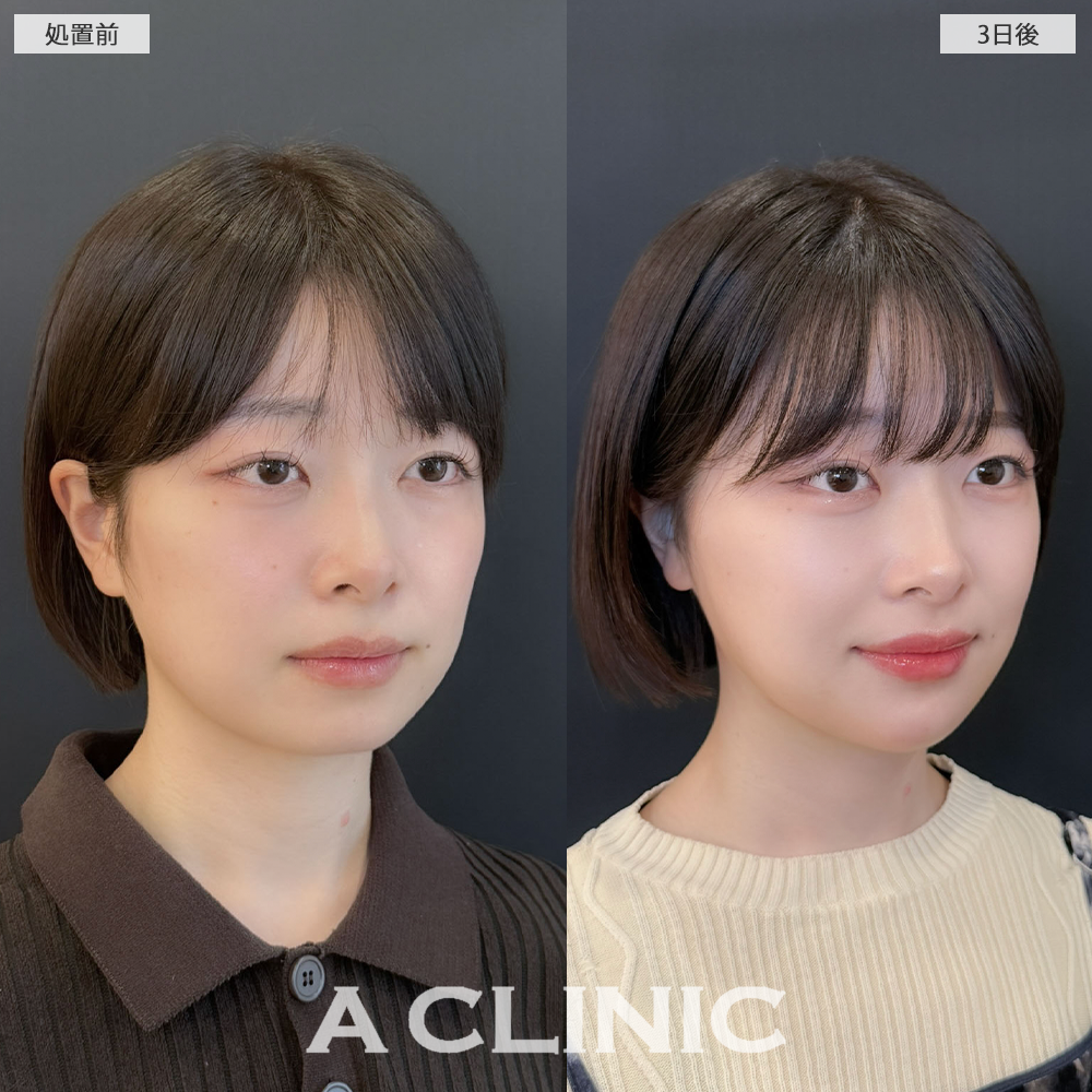 1day小顔脂肪吸引でEラインもスッキリしました！こちら処置前と3日後の症例です(20代女性)