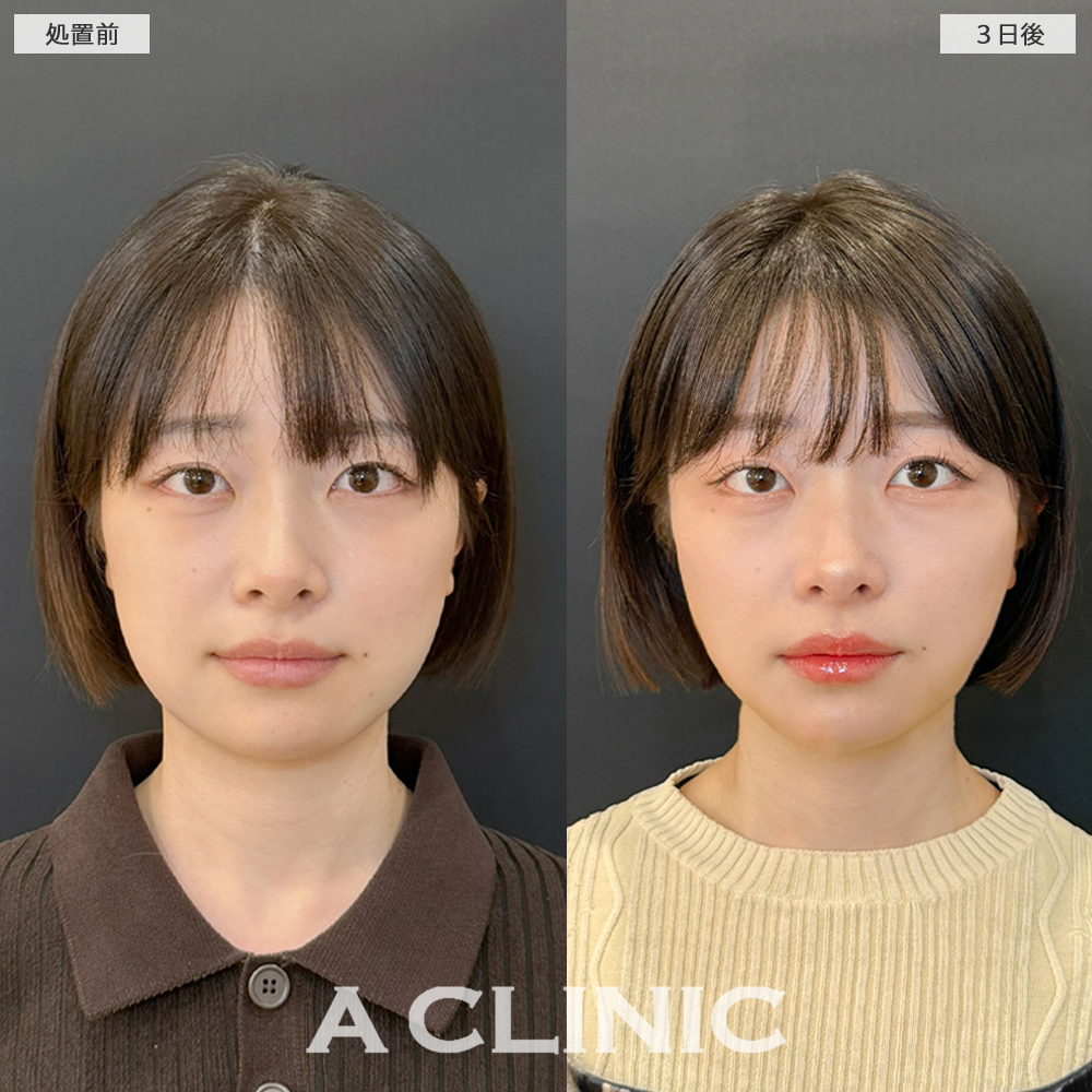 1day小顔脂肪吸引でEラインもスッキリしました！こちら処置前と3日後の症例です(20代女性)