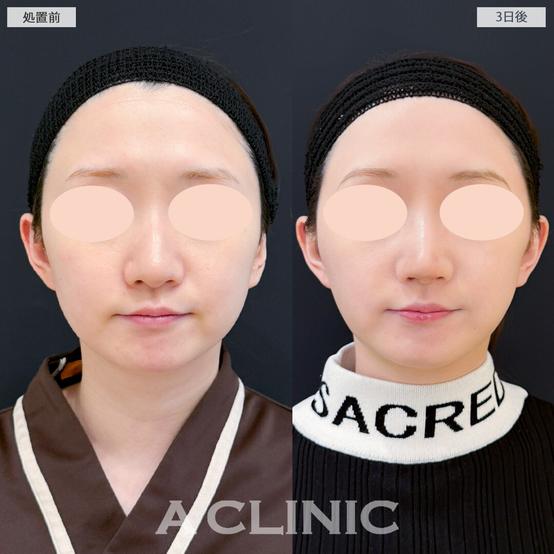 1day小顔脂肪吸引で3日後でも腫れが少なくスッキリ感を実感できました！処置前と3日後の症例です(30代女性)