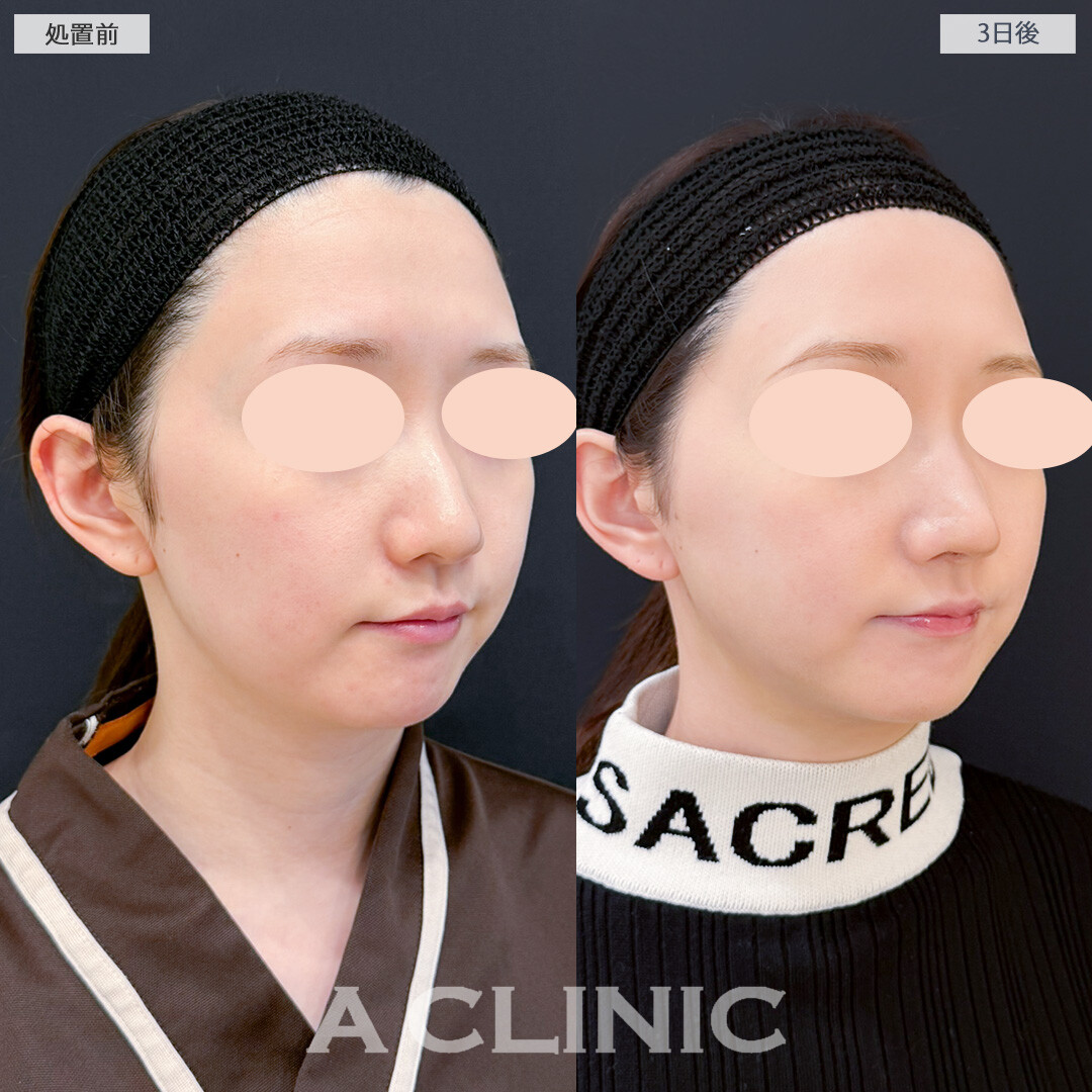 1day小顔脂肪吸引で3日後でも腫れが少なくスッキリ感を実感できました！処置前と3日後の症例です(30代女性)