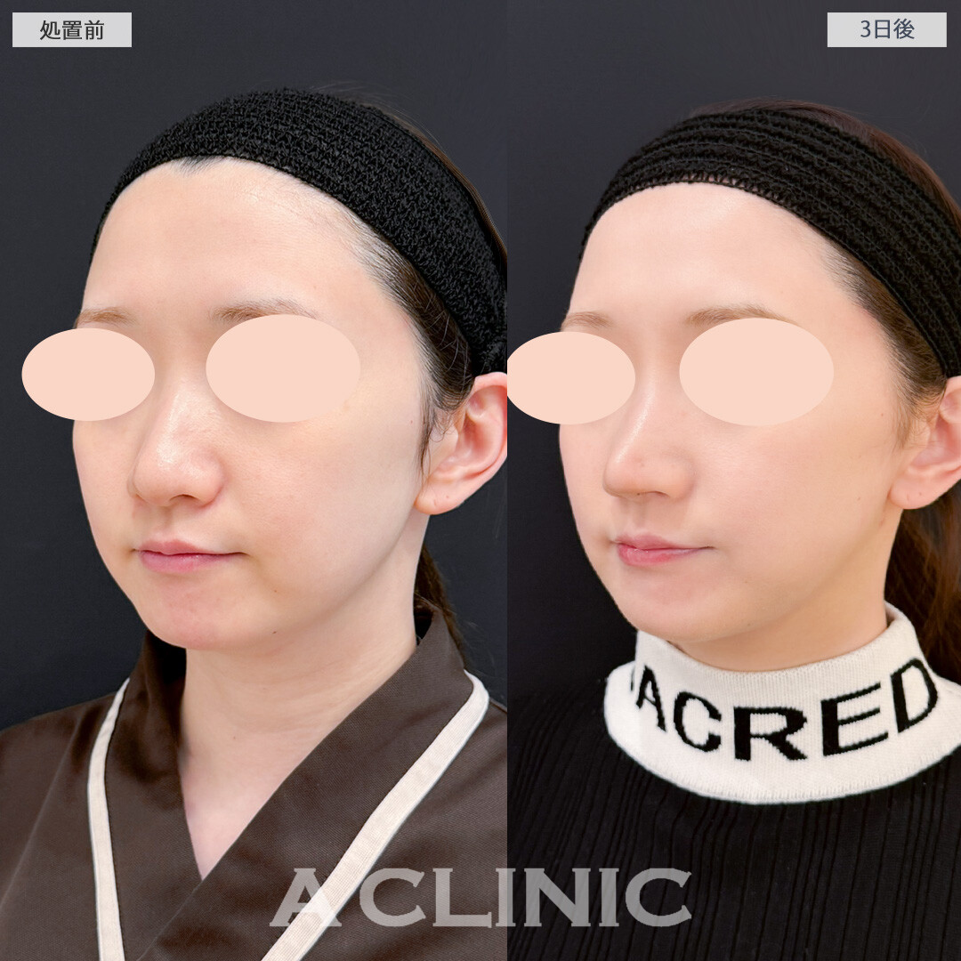 1day小顔脂肪吸引で3日後でも腫れが少なくスッキリ感を実感できました！処置前と3日後の症例です(30代女性)