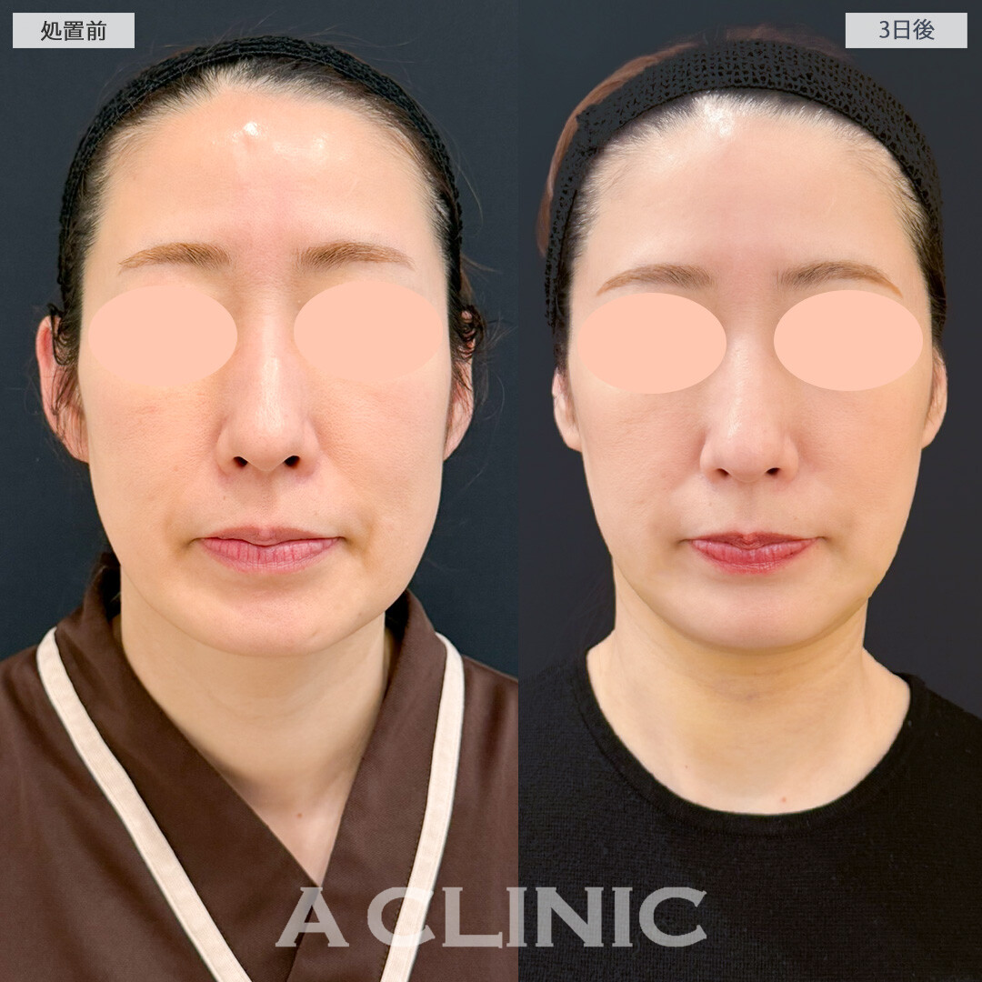 1day小顔脂肪吸引はダウンタイム中とは思えないほど腫れが気になりませんでした！処置前と3日後の症例です(40代女性)