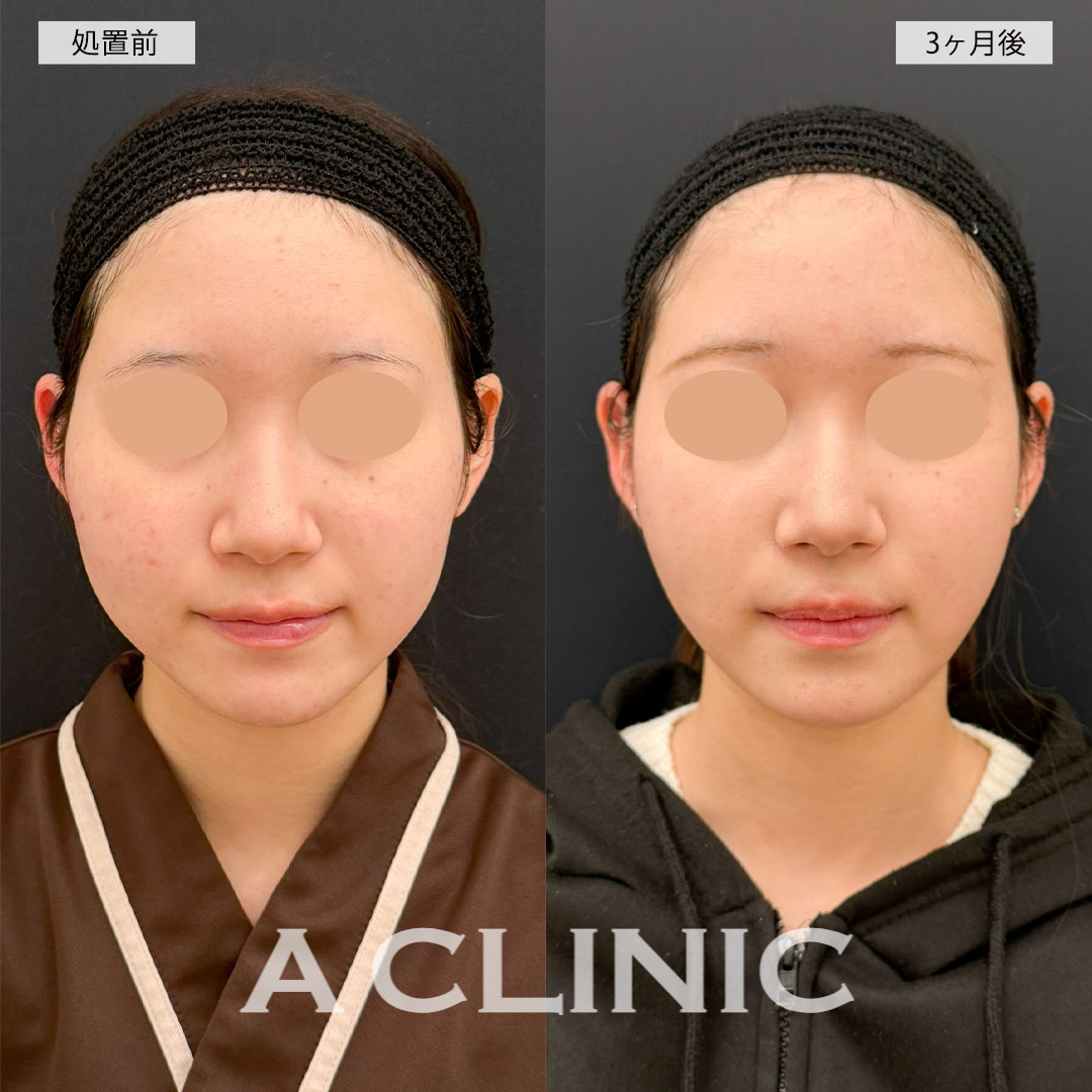 1day小顔脂肪吸引で頬の膨らみが改善されシャープな輪郭に！こちら処置前と3ヶ月後の症例です(20代女性)