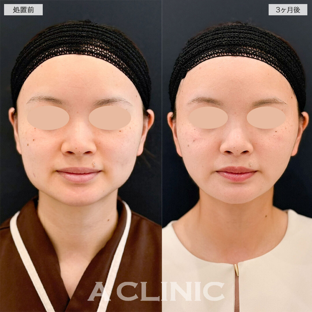 1day小顔脂肪吸引で気になる下膨れ解消！こちら処置前と3ヶ月後の症例です(20代女性)