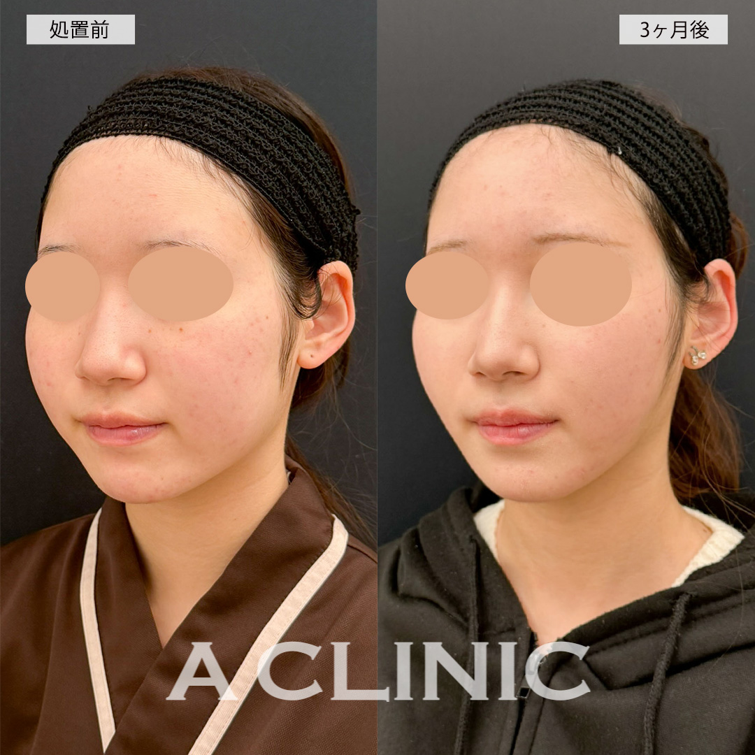 1day小顔脂肪吸引で頬の膨らみが改善されシャープな輪郭に！こちら処置前と3ヶ月後の症例です(20代女性)