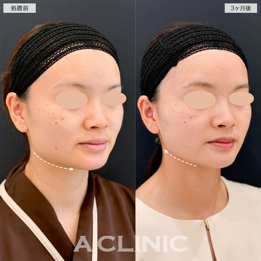 1day小顔脂肪吸引で気になる下膨れ解消！こちら処置前と3ヶ月後の症例です(20代女性)