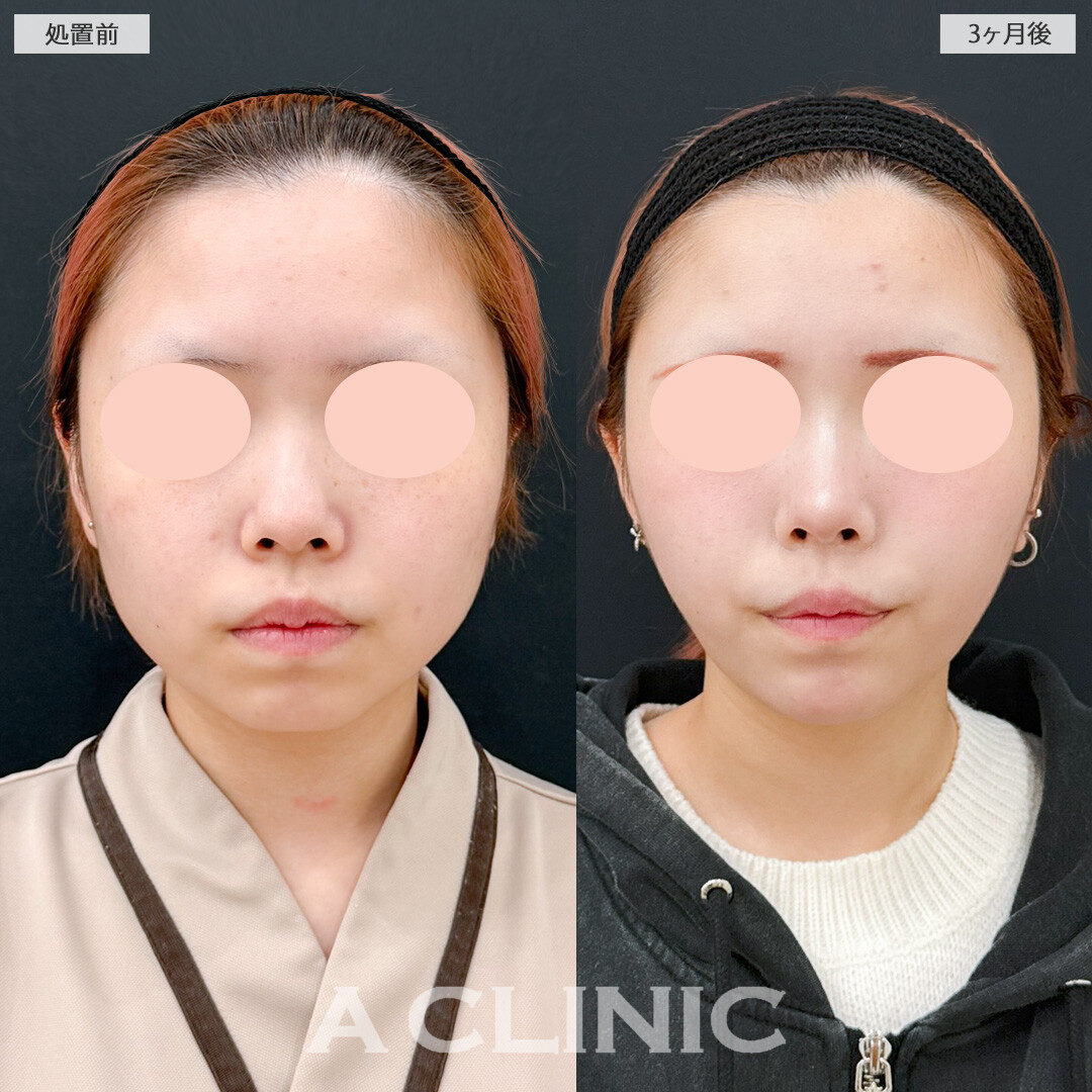 1day小顔脂肪吸引と小顔エラボトックスで時間の経過とともに小顔に変化していきます！処置前と3ヶ月後の症例です(10代女性)