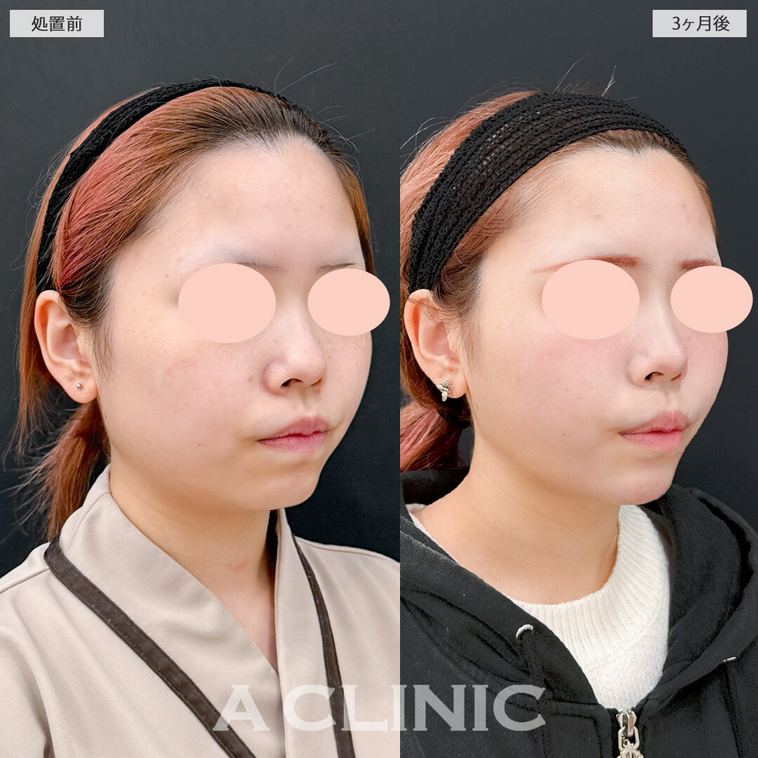 1day小顔脂肪吸引と小顔エラボトックスで時間の経過とともに小顔に変化していきます！処置前と3ヶ月後の症例です(10代女性)