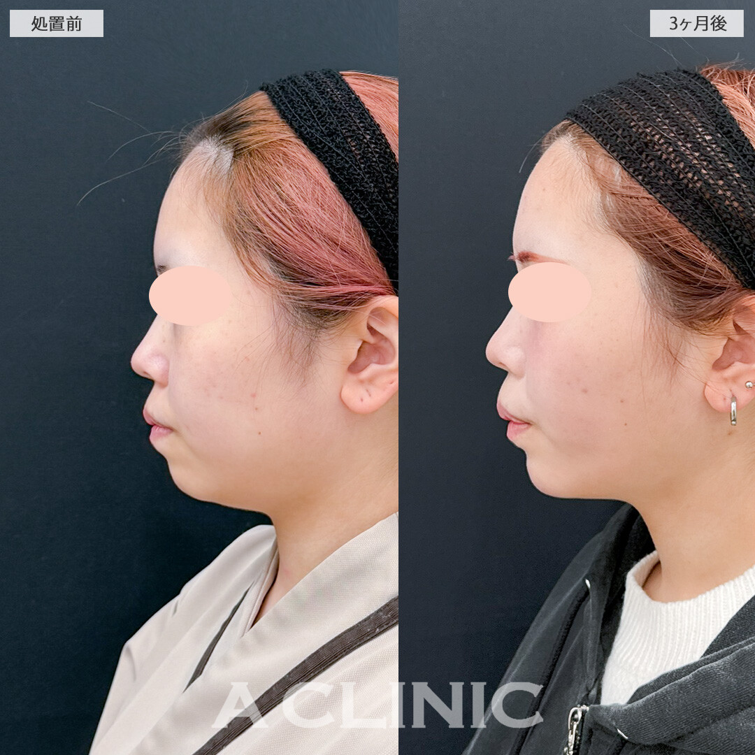 1day小顔脂肪吸引と小顔エラボトックスで時間の経過とともに小顔に変化していきます！処置前と3ヶ月後の症例です(10代女性)