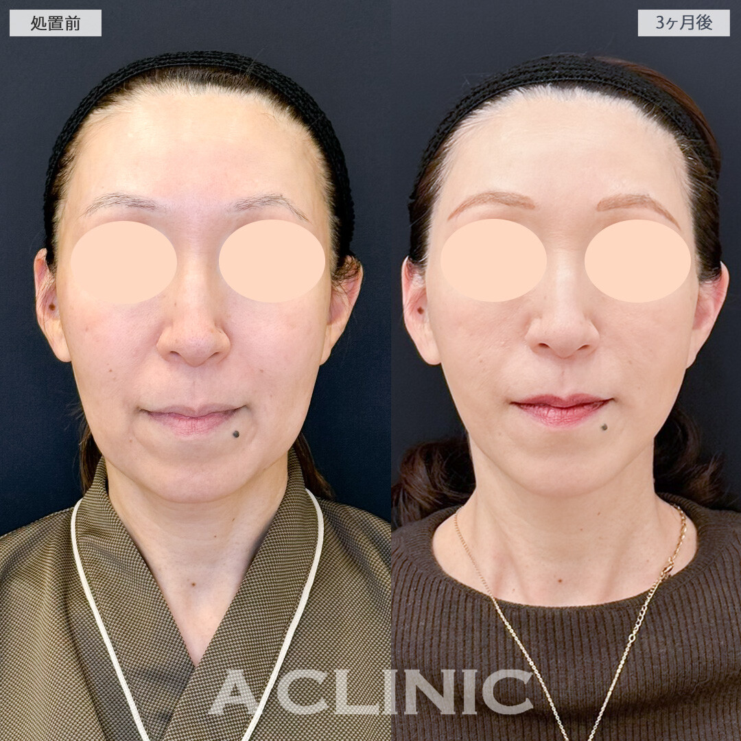 1day小顔脂肪吸引でたるみがなくなり中顔面短縮効果で老け顔予防！処置前と3ヶ月後の症例です(50代女性)