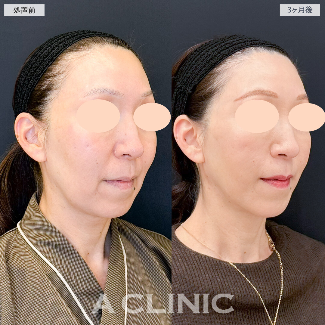 1day小顔脂肪吸引でたるみがなくなり中顔面短縮効果で老け顔予防！処置前と3ヶ月後の症例です(50代女性)
