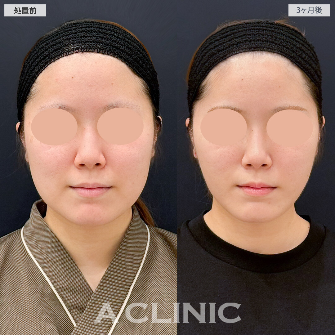 1day小顔脂肪吸引と小顔エラボトックスで輪郭を変えてお顔の印象アップデート！処置前と3ヶ月後の症例です(20代女性)