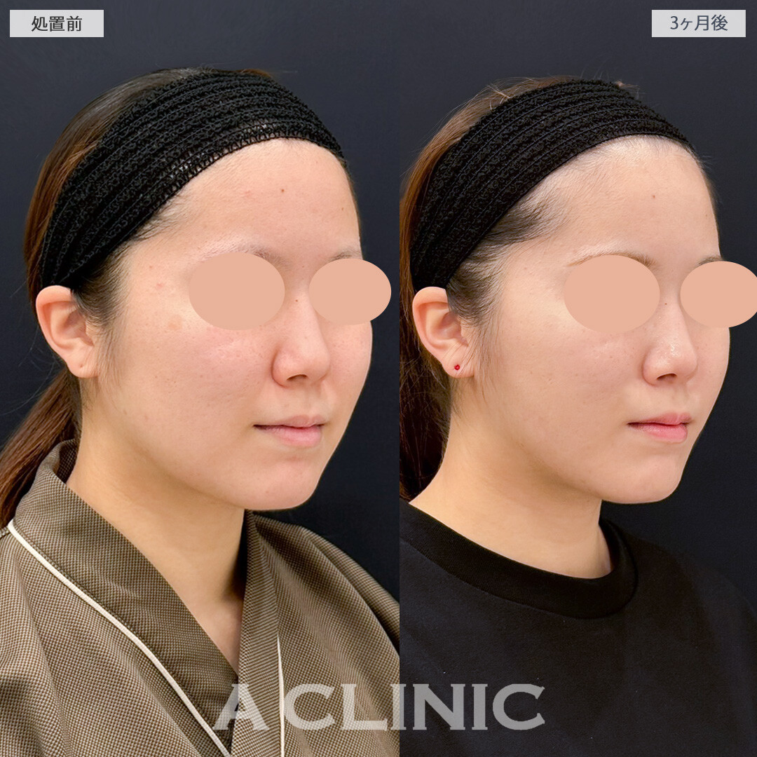 1day小顔脂肪吸引と小顔エラボトックスで輪郭を変えてお顔の印象アップデート！処置前と3ヶ月後の症例です(20代女性)