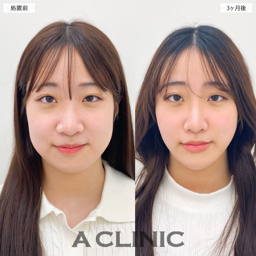 1day小顔脂肪吸引とバッカルファット除去術で下膨れ顔から綺麗な卵型フェイスに！こちら処置前と3か月後の症例です(10代女性)