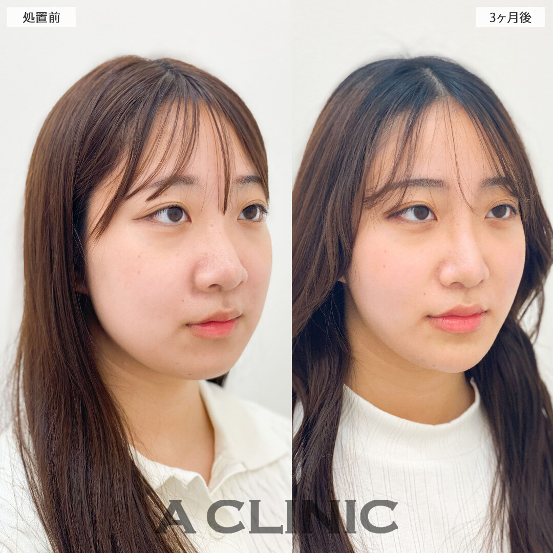 1day小顔脂肪吸引とバッカルファット除去術で下膨れ顔から綺麗な卵型フェイスに！こちら処置前と3か月後の症例です(10代女性)