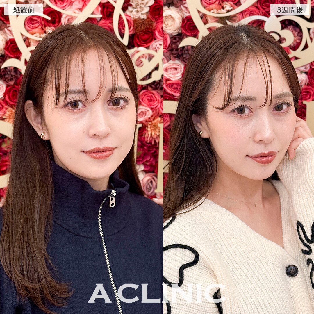 1day小顔脂肪吸引とバッカルファット除去術で笑った時の左右差解消！処置前と3週間後の症例です(30代女性)