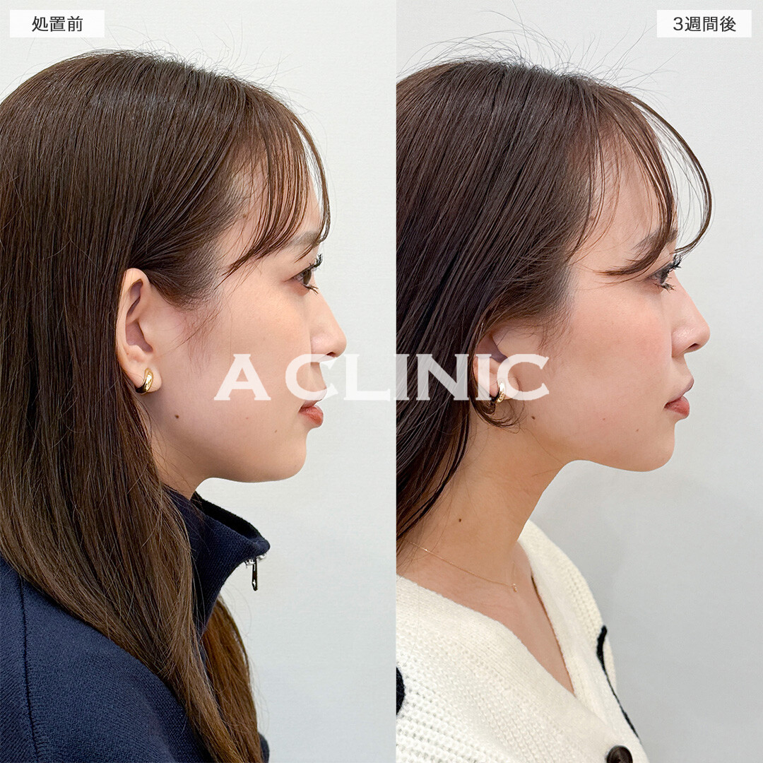 1day小顔脂肪吸引とバッカルファット除去術で笑った時の左右差解消！処置前と3週間後の症例です(30代女性)