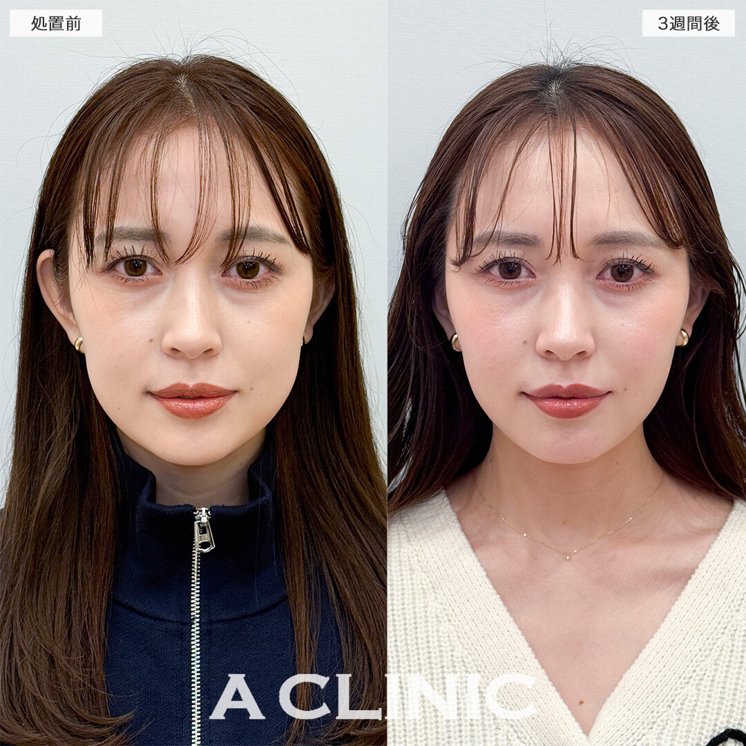 1day小顔脂肪吸引とバッカルファット除去術で笑った時の左右差解消！処置前と3週間後の症例です(30代女性)