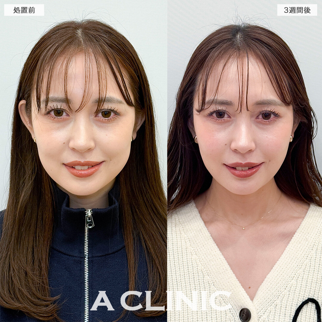 1day小顔脂肪吸引とバッカルファット除去術で笑った時の左右差解消！処置前と3週間後の症例です(30代女性)