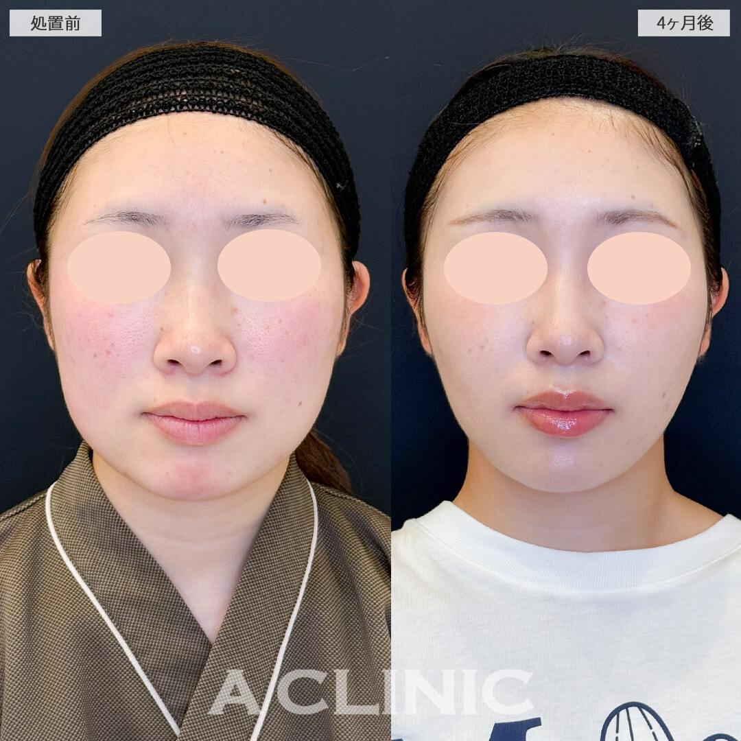 1day小顔脂肪吸引と小顔エラボトックスでスッキリ小顔フェイスにアップデート！処置前と4ヶ月後の症例です(20代女性)