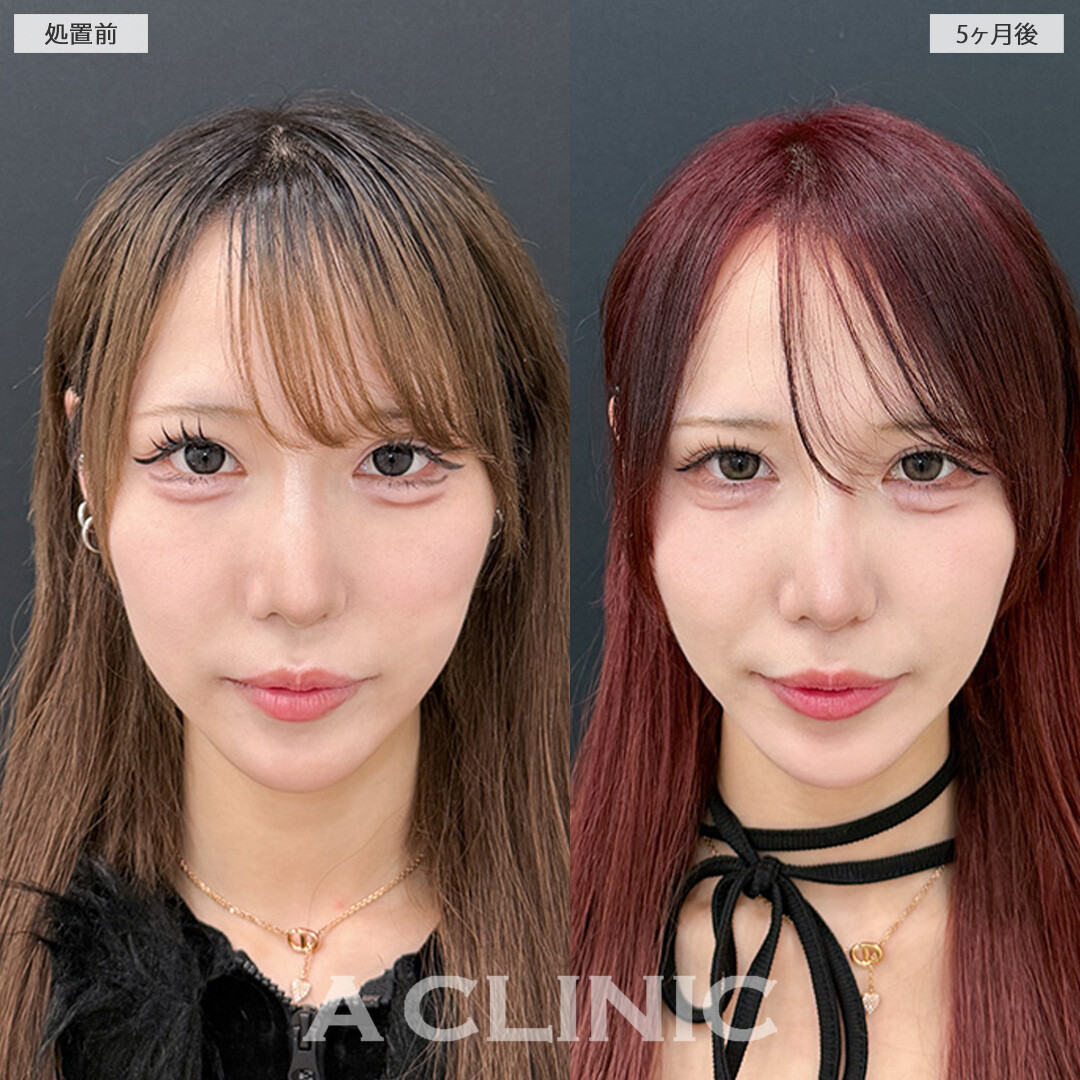 1day小顔脂肪吸引で横から見た時のアゴ下のお肉が軽減しフェイスラインがすっきりしました！処置前と5ヶ月後の症例です(20代女性)
