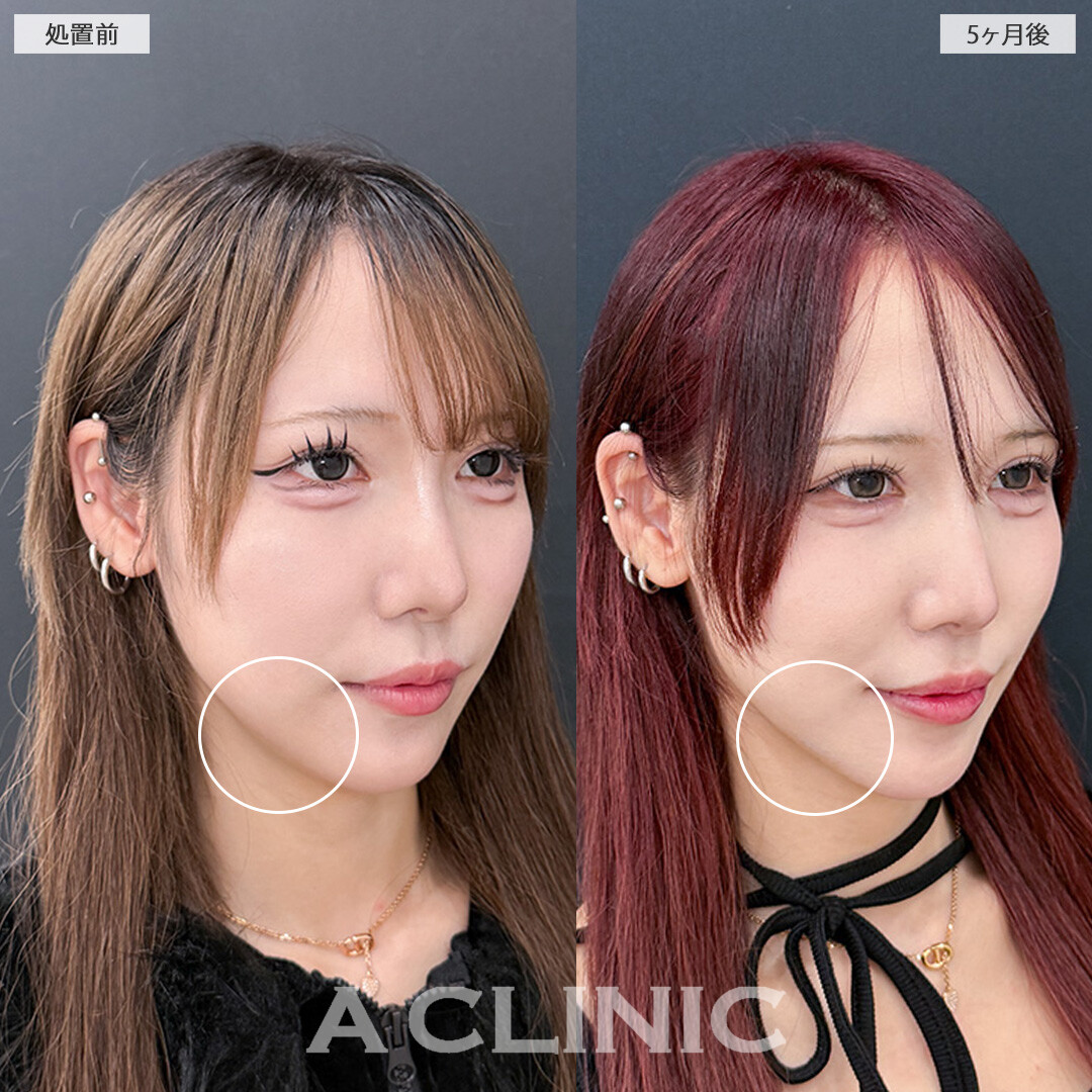 1day小顔脂肪吸引で横から見た時のアゴ下のお肉が軽減しフェイスラインがすっきりしました！処置前と5ヶ月後の症例です(20代女性)