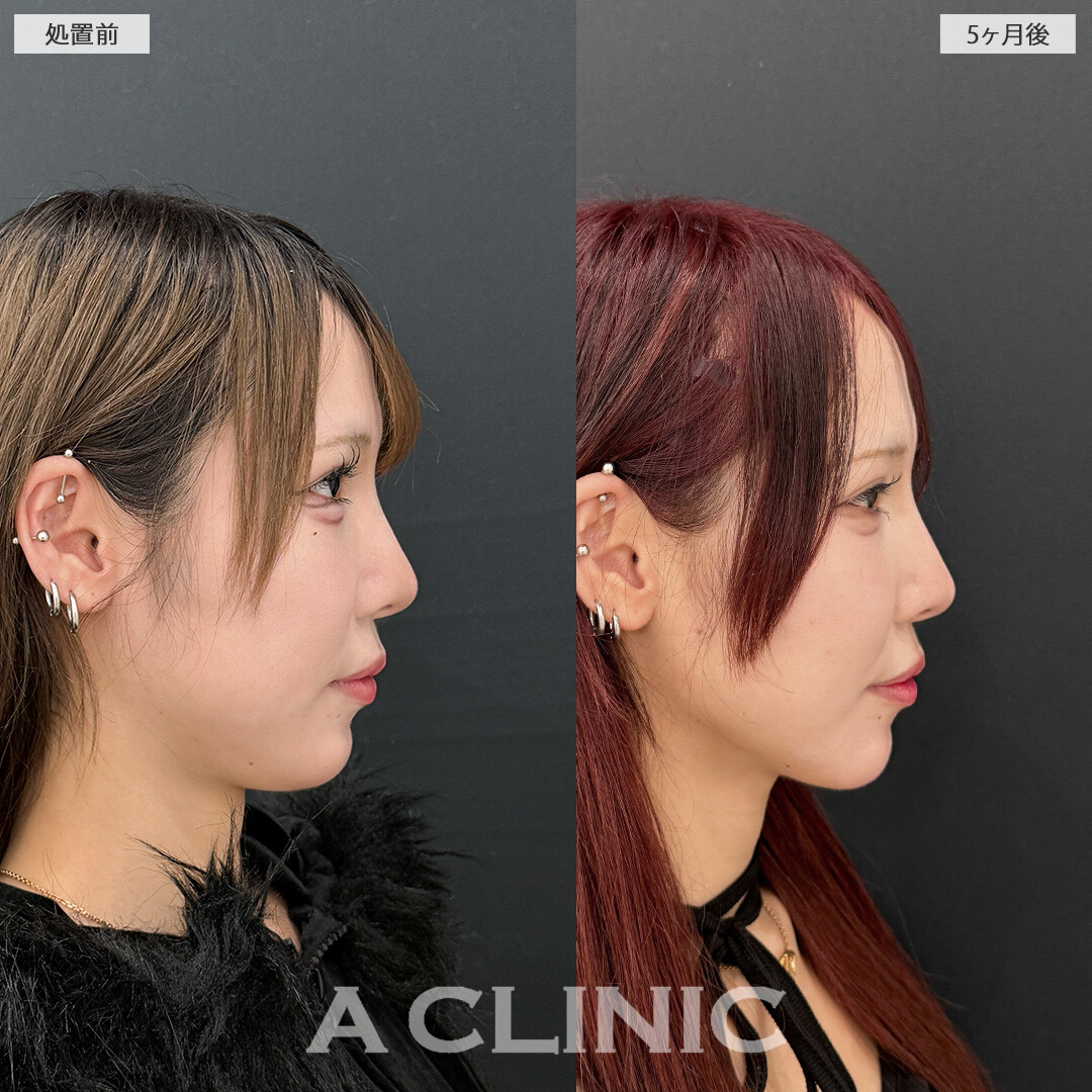 1day小顔脂肪吸引で横から見た時のアゴ下のお肉が軽減しフェイスラインがすっきりしました！処置前と5ヶ月後の症例です(20代女性)