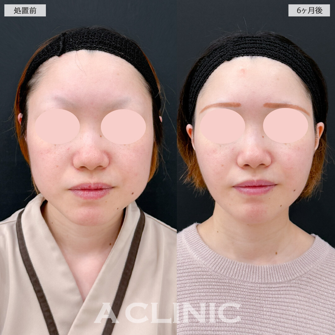 1day小顔脂肪吸引とバッカルファット除去術で後戻りしにくい小顔に変化！処置前と6ヶ月後の症例です(20代女性)