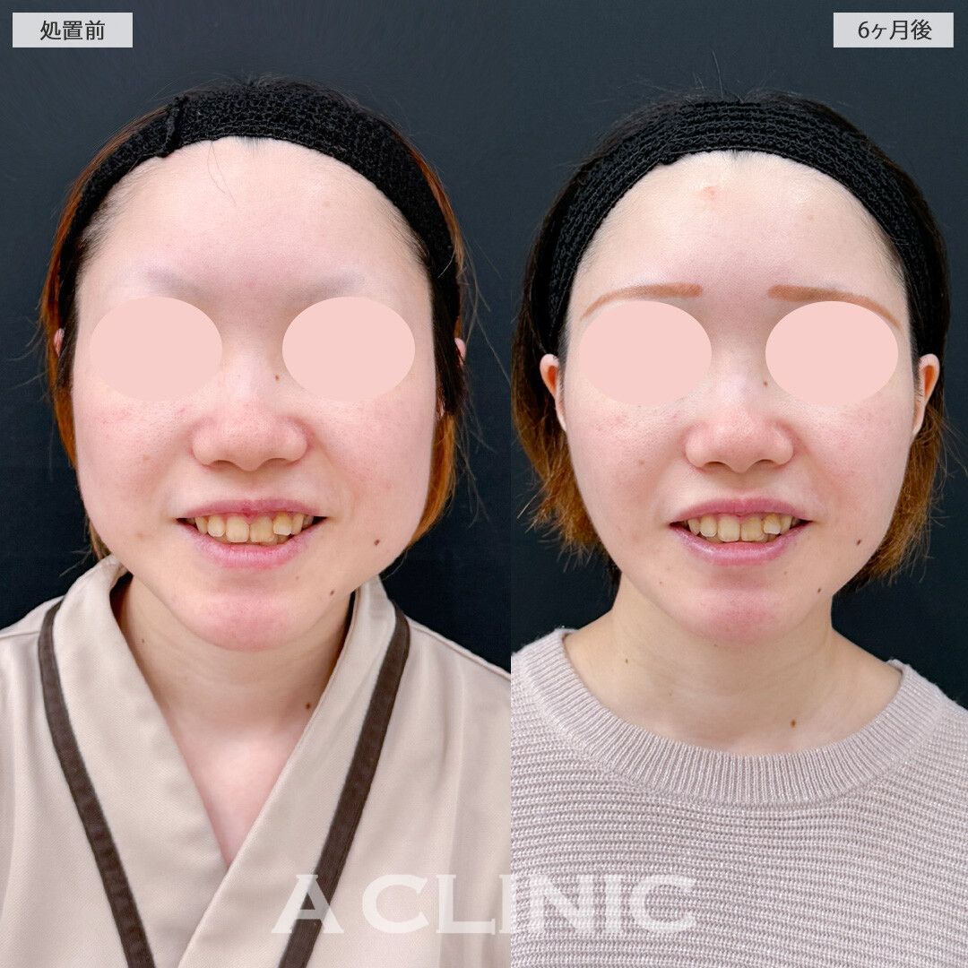 1day小顔脂肪吸引とバッカルファット除去術で後戻りしにくい小顔に変化！処置前と6ヶ月後の症例です(20代女性)