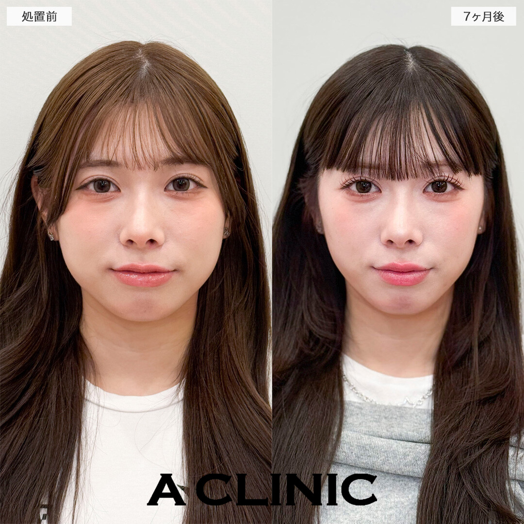 1day小顔脂肪吸引とバッカルファット除去術で半年経っても綺麗な輪郭をキープ！処置前と7ヶ月後の症例です(20代女性)