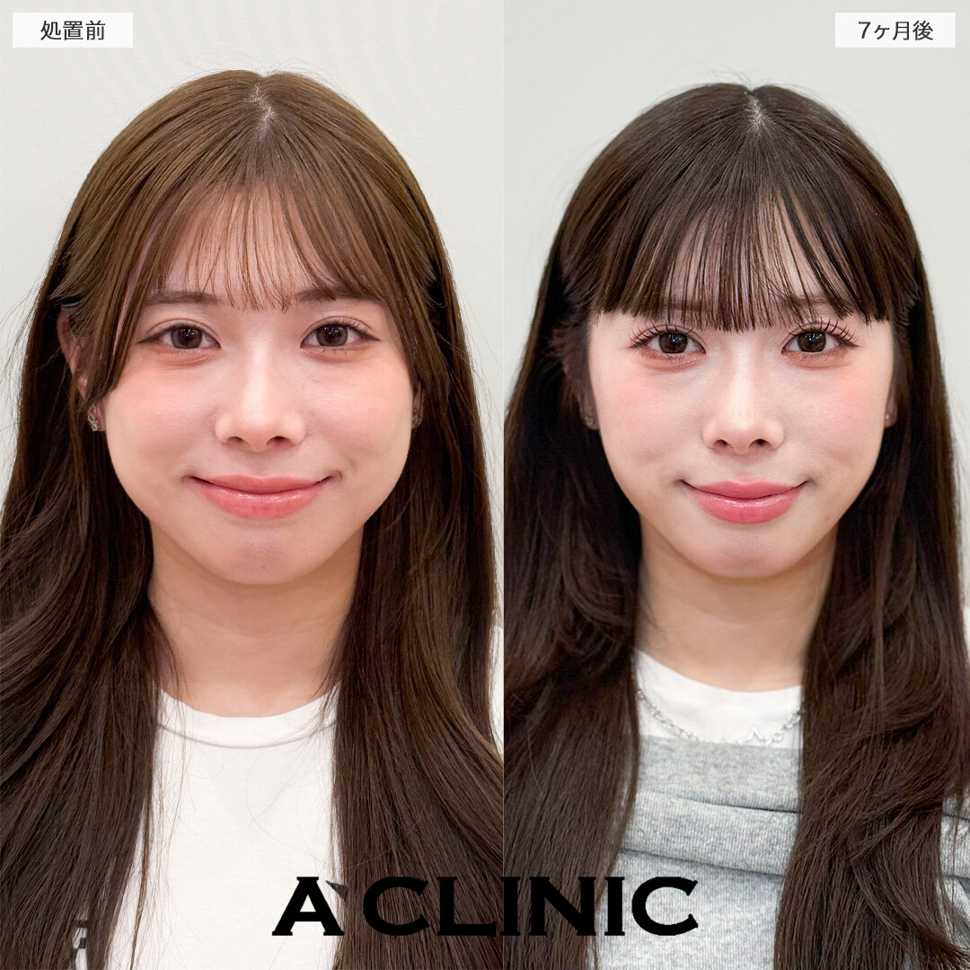 1day小顔脂肪吸引とバッカルファット除去術で半年経っても綺麗な輪郭をキープ！処置前と7ヶ月後の症例です(20代女性)